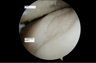 3-daraja osteoartrit bilan tiz qo'shma bo'yicha astroscope xil