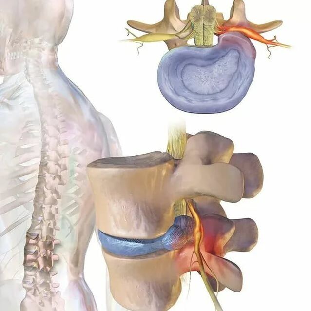 intervertebral disk bilan bog'liq muammolar