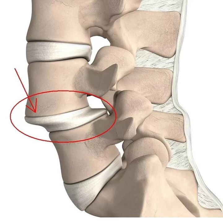 vertebra shikastlanishlari