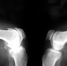 Osteoartrit x-ray haqida