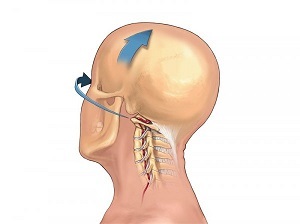 servikal o'murtqa osteoxondroz o'zini qanday namoyon qiladi