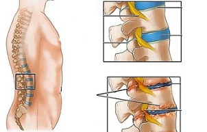 bel umurtqasi osteoxondrozining sabablari