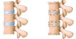 bel umurtqasining osteoxondrozini qanday aniqlash mumkin