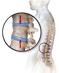 Osteoporoz bel sohasidagi bel og'rig'ini qo'zg'atadi